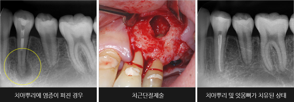 치근단절제술